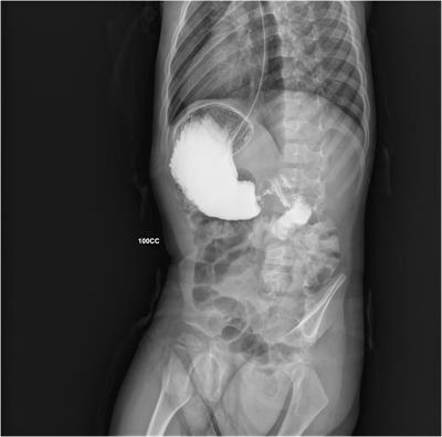 Case report: Late-onset hypertrophic pyloric stenosis in a 3-year-old boy: It is never too late